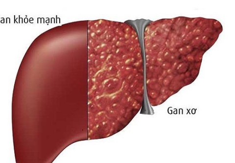 Gan người phụ nữ nhiễm mỡ bị xơ thành dải trắng xóa